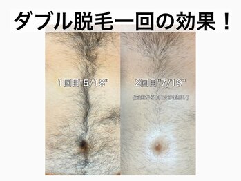 ブラジリアンワックス&光脱毛サロン　　　　　　No.A 恵比寿店【ナンバーエー】/"当店一番人気！ダブル脱毛"