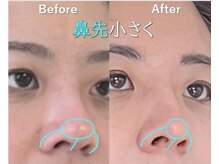 ラプリボヤージュ 藤沢店(Raplit)の雰囲気(鼻は一度高くなるとほぼ戻らない!#隆鼻矯正#小顔#藤沢#ラプリ)