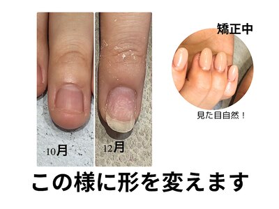 1日で見た目を変えます 深爪 爪を噛む 方