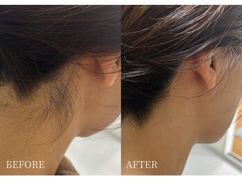 エース(ACE.)/首元スッキリ☆うなじ脱毛