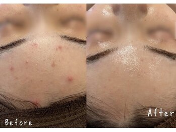 エヌエースキン 北谷店(NAskin)/ハーブピーリング｜ニキビケア