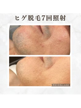 ボゴス(BOGOSS)/ヒゲ脱毛7回照射