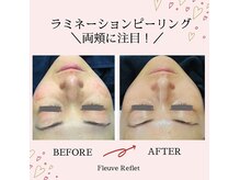 モヤっとくすみにはソフトピーリング×ビタミンC