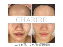 ハーブピーリングで肌管理！ツヤ肌に！ニキビ/フェイシャル/シミ