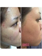 リメレ(Rimere)/ニキビケア