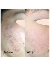サロン ピューパ(Salon pupa)/女性ニキビケア　before →after