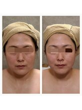 ウォーマル(warmaL)/小顔矯正/4回施術で骨格も変身！