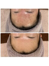 エムリシェ(M.riche)/ハーブピーリング