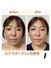 【リフトアップ/美白/艶肌】専用美顔器使用リアボーテフルスキンケア体験