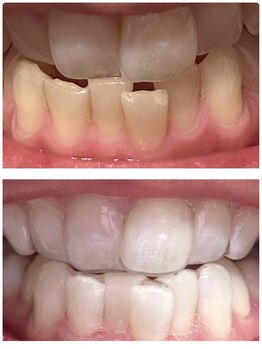ラシック(Rachic)/脅威のホワイトニング効果