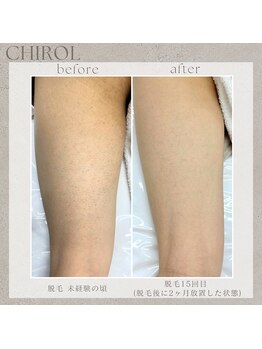 チロル(CHIROL)/