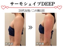 スパイア(SPIRE)/サーモシェィプDEEP★二の腕