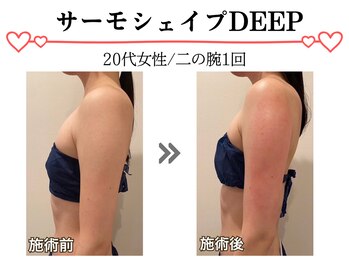 スパイア(SPIRE)/サーモシェィプDEEP★二の腕