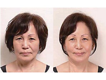 しわ・たるみ専用美顔サロン　Avelleの写真/小じわ・ほうれい線・マリオネットライン・ツヤがないなど老け顔にお悩みの方へ◇