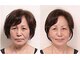 しわ・たるみ専用美顔サロン　Avelleの写真/小じわ・ほうれい線・マリオネットライン・ツヤがないなど老け顔にお悩みの方へ◇