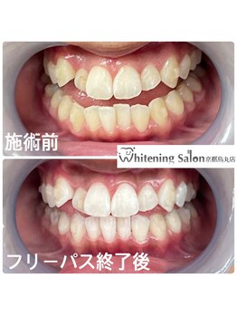 ホワイトニングサロン 京都烏丸店/ホワイトニング施術例