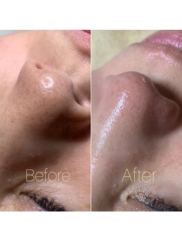 セリジェ 青山(Cerisier)/人気の毛穴エクストラクション♪