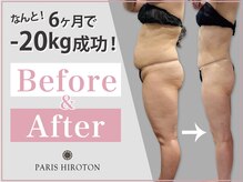 パリスヒロトン(PARIS HIROTON)の雰囲気（【40代女性】6ヶ月目の症例写真です。しっかりサポート痩身♪）