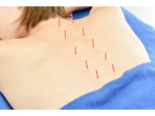 そら鍼灸接骨院 イオンモールつくば店/筋疲労スポーツごのケアに