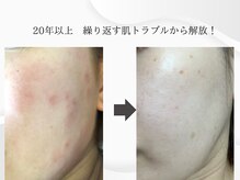 ベリル(BERYL)/敏感肌/ハーブピーリング