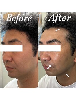 コリー(Kolly)/リフトアップ！！