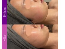 クレヴィア バイ サイバーエステ(CREBIA)/【小顔コルギ】即効性あり☆