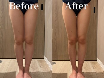 モリタ鍼灸整骨院/辛いむくみ足→シンデレラ美脚へ