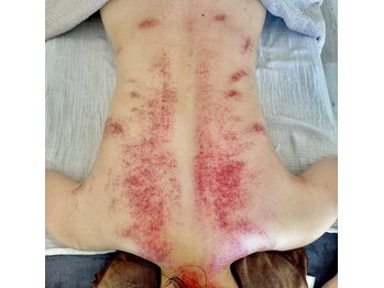 ビレイ(Birei)/カッサ