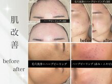 お肌にあった施術を提案し、お肌改善、お肌管理をさせて頂きます