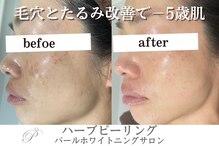 【シミケア/ハーブピーリング専門店】パールホワイトニングサロン　大船店