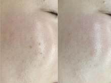 《毛穴・シミ・シワ・たるみ》大人の肌悩みもまるごとケア◎