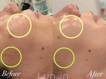 ルノン(Lunon)/毛穴洗浄ハイドロ×ララピール