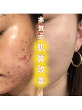 サロンドマヒナ(Salon da Mahina)&nbsp;肌悩み 根本改善