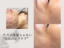 レイミー(reimee)の雰囲気（結果重視◎SNSでも話題の《ゾンビマスク》で攻めのシワケア）