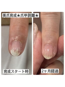 マニュコクーン(ManuCocoon)/爪育成 深爪 巻き爪 大阪市
