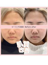 ディアメ(Diame)/肌質改善アクネ菌撃退ピーリング