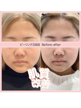 ディアメ(Diame)/肌質改善アクネ菌撃退ピーリング