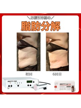 トータルビューティーサロン ヴィヴィエ(ViVier)/脂肪分解　お腹症例6回