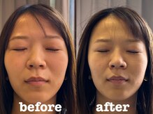 ソラナ(Solana)/美容鍼（百華鍼）