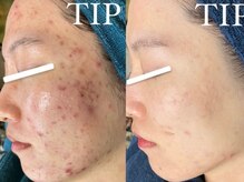 ダリア(Dahlia)/ハーブピーリング