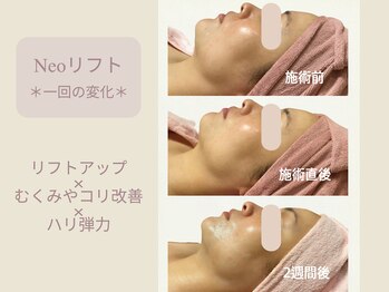 エステティックサロン アールグレー 名古屋駅店/切らないリフト/変化実感◎