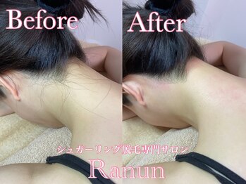 ラナン(Ranun)/痛み最小限のシュガーリング脱毛