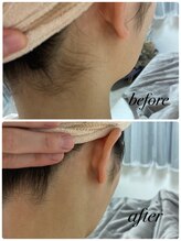 ティティー(tity)/うなじ脱毛♪