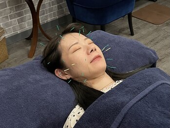 ビースタイル(B-style)/【美容鍼灸】電気美容鍼灸施術