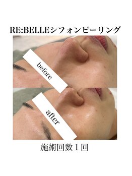 サラ/Re:belleシフォンピーリング