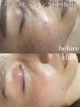 ビエン(bien)/施術6回.陶肌ハーブピーリング