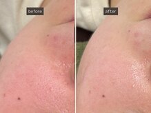 SEC(Shizuoka esthetic company)/【肌質改善】光フェイシャル