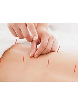 鍼灸施術を受けたい