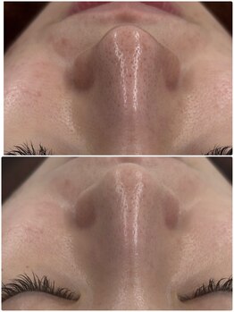 プログレス(PROGRESS)/毛穴スッキリ　水光ピーリング