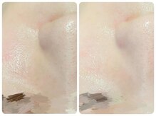 トータルビューティ ノイド(Noid)/毛穴洗浄　全顔フル